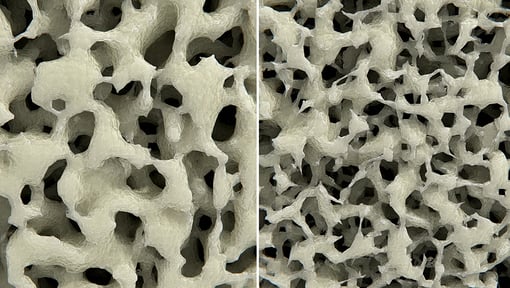The left side of the image shows healthy bone tissue, the right side of the image shows osteoporosis. 