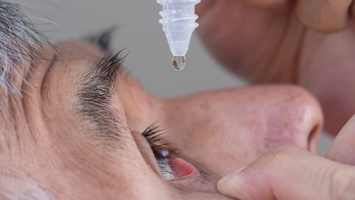 Close-up of eye drops being applied to an eye for treatment of dry eye.